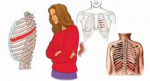 Đau dây thần kinh liên sườn - Ảnh 1. Đau dây thần kinh liên sườn - Ảnh 1.