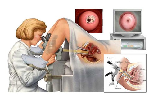 Phát hiện sớm ung thư cổ tử cung bằng phương pháp soi cổ tử cung - Ảnh 1. Phát hiện sớm ung thư cổ tử cung bằng phương pháp soi cổ tử cung - Ảnh 1.