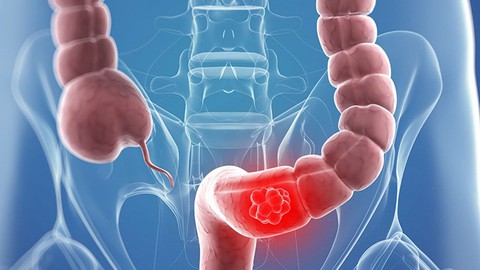 Ung thư không gây tử vong nếu phát hiện sớm và điều trị kịp thời - Ảnh 1. Ung thư không gây tử vong nếu phát hiện sớm và điều trị kịp thời - Ảnh 1.