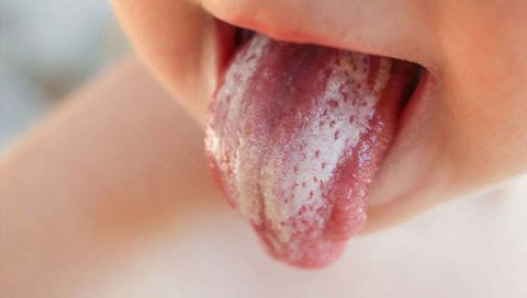 Trẻ bị nhiễm nấm Candida - Ảnh 1. Trẻ bị nhiễm nấm Candida - Ảnh 1.