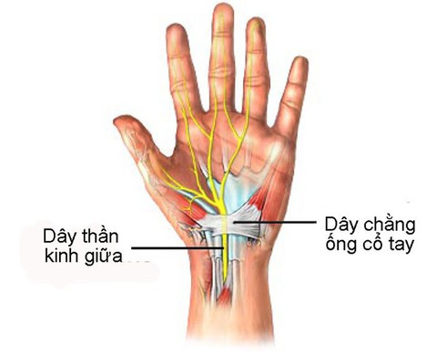 Hội chứng ống cổ tay - Ảnh 1. Hội chứng ống cổ tay - Ảnh 1.