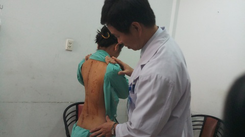 Thiếu nữ 15 tuổi có cột sống cong vẹo như chữ S - Ảnh 2. Thiếu nữ 15 tuổi có cột sống cong vẹo như chữ S - Ảnh 2.