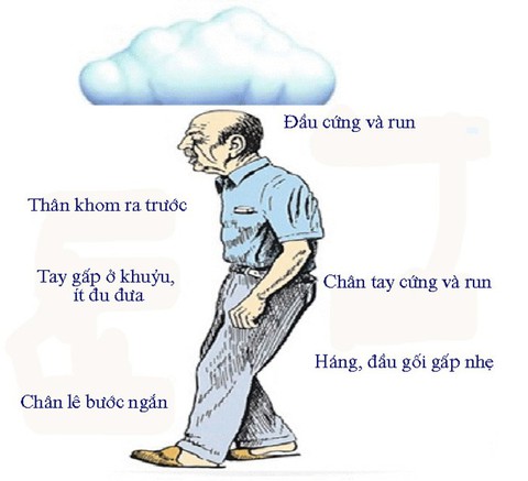 Ngăn chặn tàn tật do bệnh Parkinson - Ảnh 1. Ngăn chặn tàn tật do bệnh Parkinson - Ảnh 1.