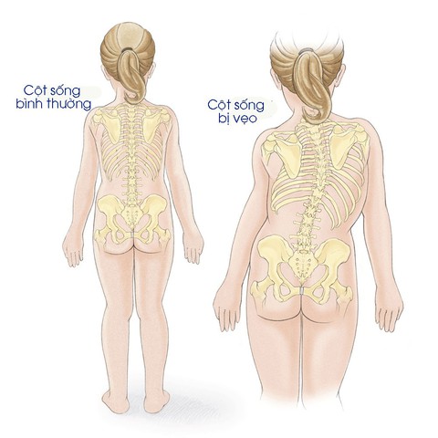 Tật cong vẹo cột sống ảnh hưởng đến chất lượng cuộc sống của trẻ - Ảnh 1. Tật cong vẹo cột sống ảnh hưởng đến chất lượng cuộc sống của trẻ - Ảnh 1.