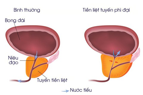 Phì đại tiền liệt tuyến - Ảnh 1. Phì đại tiền liệt tuyến - Ảnh 1.