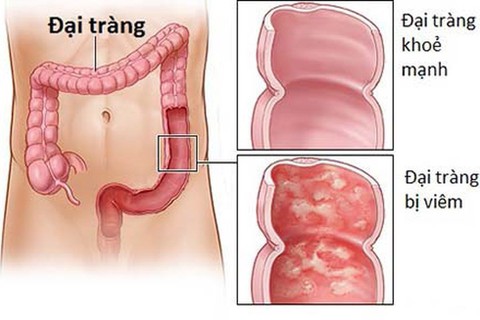 Những điều cần biết về viêm loét đại tràng - Ảnh 1. Những điều cần biết về viêm loét đại tràng - Ảnh 1.