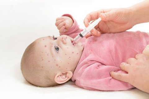 Cách xử trí sốt phát ban tại nhà - Ảnh 1. Cách xử trí sốt phát ban tại nhà - Ảnh 1.