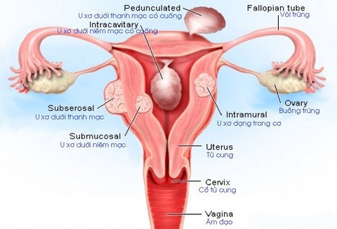 U xơ tử cung ở phụ nữ độc thân - Ảnh 1. U xơ tử cung ở phụ nữ độc thân - Ảnh 1.