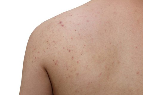 Điều trị mụn trứng cá ở lưng và ngực - Ảnh 1. Điều trị mụn trứng cá ở lưng và ngực - Ảnh 1.