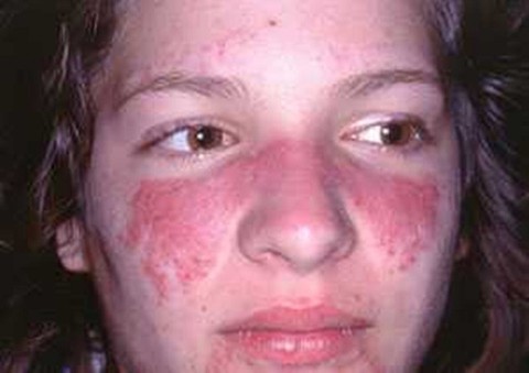 Lupus ban đỏ, căn bệnh nguy hiểm ít được biết đến - Ảnh 1. Lupus ban đỏ, căn bệnh nguy hiểm ít được biết đến - Ảnh 1.