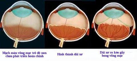 Giúp trẻ sinh non thoát khỏi nguy cơ mù lòa - Ảnh 1. Giúp trẻ sinh non thoát khỏi nguy cơ mù lòa - Ảnh 1.