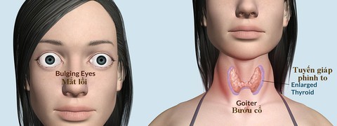 Bạn có biết về bệnh basedow? - Ảnh 1. Bạn có biết về bệnh basedow? - Ảnh 1.