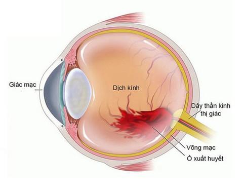 Xuất huyết dịch kính: Chẩn đoán và điều trị - Ảnh 1. Xuất huyết dịch kính: Chẩn đoán và điều trị - Ảnh 1.