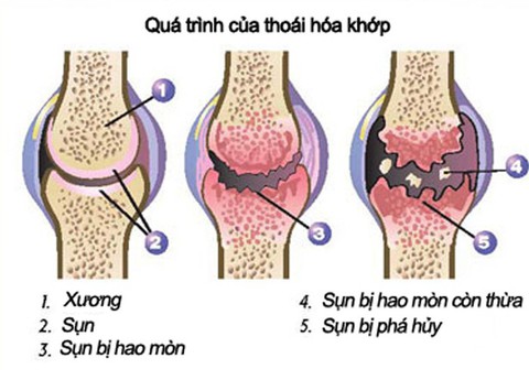 10 cách ngăn ngừa thoái hóa khớp - Ảnh 1. 10 cách ngăn ngừa thoái hóa khớp - Ảnh 1.