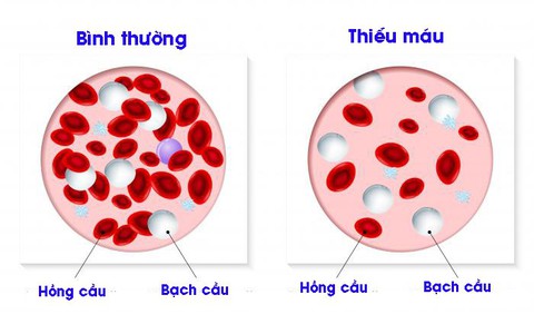 Hội chứng thiếu máu - Ảnh 1. Hội chứng thiếu máu - Ảnh 1.