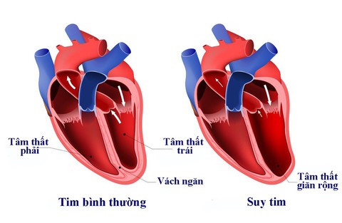 Bệnh suy tim - Ảnh 1. Bệnh suy tim - Ảnh 1.