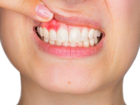 Viêm lợi: Hiểu biết và cách phòng ngừa - Ảnh 1. Viêm lợi: Hiểu biết và cách phòng ngừa - Ảnh 1.