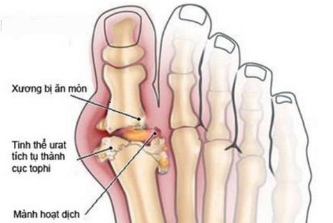 Có phòng ngừa tái phát bệnh gout được không? - Ảnh 1. Có phòng ngừa tái phát bệnh gout được không? - Ảnh 1.