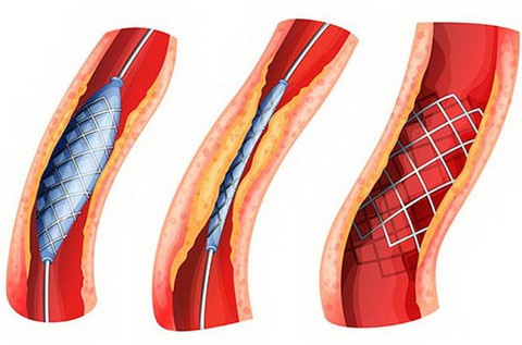 Sáng chế mới trong điều trị tắc nghẽn mạch máu - Ảnh 2. Sáng chế mới trong điều trị tắc nghẽn mạch máu - Ảnh 2.