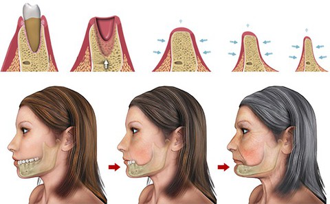 Nha khoa cấy ghép Implant cho người bị mất răng lâu năm - Ảnh 2. Nha khoa cấy ghép Implant cho người bị mất răng lâu năm - Ảnh 2.