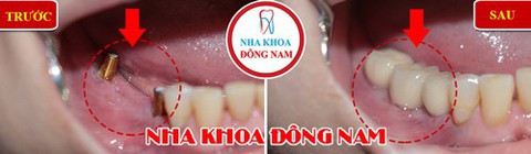 Nha khoa cấy ghép Implant cho người bị mất răng lâu năm - Ảnh 3. Nha khoa cấy ghép Implant cho người bị mất răng lâu năm - Ảnh 3.