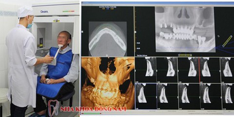 Nha khoa cấy ghép Implant cho người bị mất răng lâu năm - Ảnh 4. Nha khoa cấy ghép Implant cho người bị mất răng lâu năm - Ảnh 4.