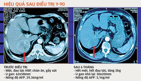 Thuốc ung thư Lipiodol tăng giá liên tục vì độc quyền - Ảnh 1. Thuốc ung thư Lipiodol tăng giá liên tục vì độc quyền - Ảnh 1.
