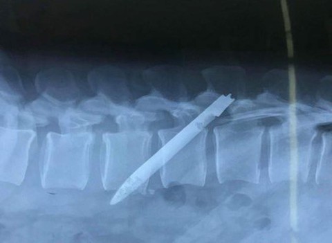 Lưỡi dao 13cm ‘ngủ quên’ ở lưng chiến sĩ công an suốt 11 năm - Ảnh 1. Lưỡi dao 13cm ‘ngủ quên’ ở lưng chiến sĩ công an suốt 11 năm - Ảnh 1.