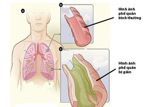 Bệnh giãn phế quản - Ảnh 1. Bệnh giãn phế quản - Ảnh 1.