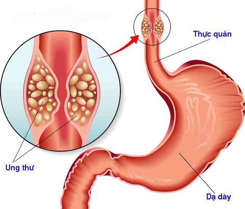 6 dấu hiệu nhận biết ung thư thực quản - Ảnh 1. 6 dấu hiệu nhận biết ung thư thực quản - Ảnh 1.