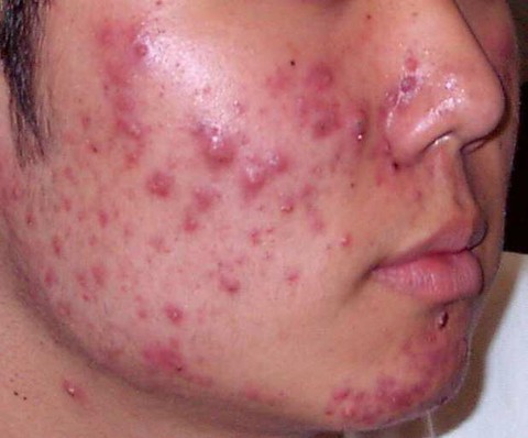 Chăm sóc và điều trị mụn trứng cá nặng - Ảnh 1. Chăm sóc và điều trị mụn trứng cá nặng - Ảnh 1.
