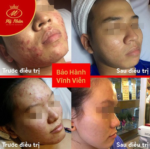 Trị mụn hiệu quả với công nghệ quang xung bước sóng nano - Ảnh 1. Trị mụn hiệu quả với công nghệ quang xung bước sóng nano - Ảnh 1.