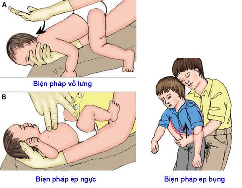 Xử trí trẻ hóc các loại hạt - Ảnh 1. Xử trí trẻ hóc các loại hạt - Ảnh 1.