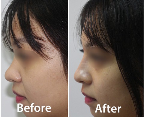 Những điều chị em nên biết khi làm đẹp bằng Filler - Ảnh 1. Những điều chị em nên biết khi làm đẹp bằng Filler - Ảnh 1.