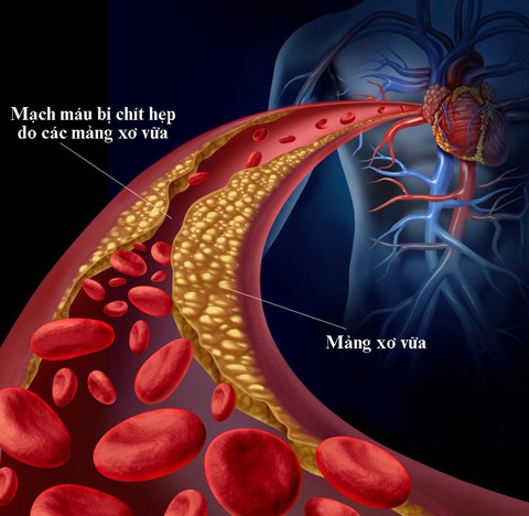 Cách ngăn ngừa rối loạn lipid máu - Ảnh 1. Cách ngăn ngừa rối loạn lipid máu - Ảnh 1.