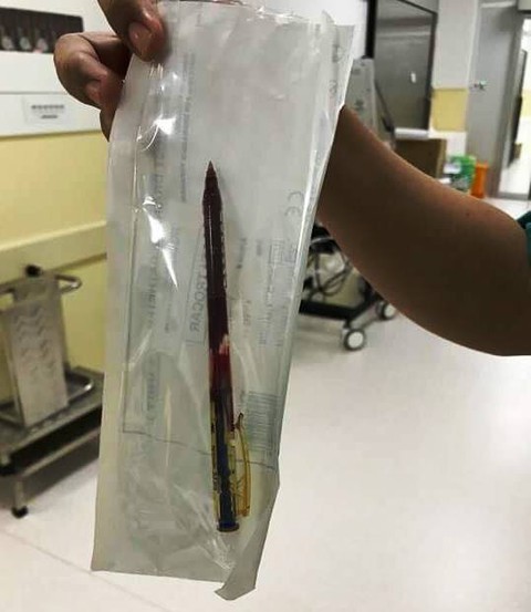 Cứu sống bé gái bị bút bi đâm thấu ngực - Ảnh 2. Cứu sống bé gái bị bút bi đâm thấu ngực - Ảnh 2.