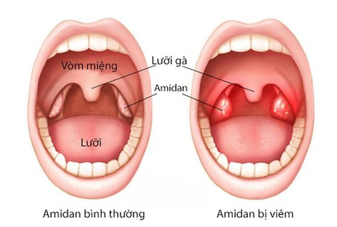 Phòng ngừa amidan “dở chứng” - Ảnh 1. Phòng ngừa amidan “dở chứng” - Ảnh 1.