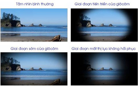 Bệnh glôcôm nhãn áp bình thường - Ảnh 1. Bệnh glôcôm nhãn áp bình thường - Ảnh 1.