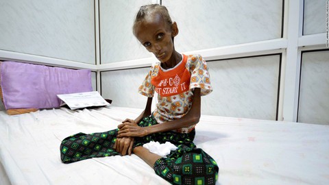 Ở Yemen, đến khóc cũng không còn nước mắt vì đói khát - Ảnh 2. Ở Yemen, đến khóc cũng không còn nước mắt vì đói khát - Ảnh 2.