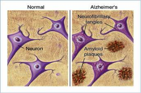Tìm ra cách phát hiện Alzheimer trước 15 năm - Ảnh 2. Tìm ra cách phát hiện Alzheimer trước 15 năm - Ảnh 2.