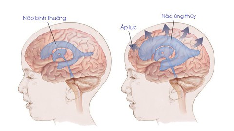 Não úng thủy ở trẻ em - Ảnh 1. Não úng thủy ở trẻ em - Ảnh 1.