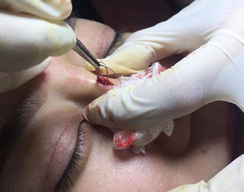Nâng mũi bằng chỉ dễ tai biến - Ảnh 1. Nâng mũi bằng chỉ dễ tai biến - Ảnh 1.