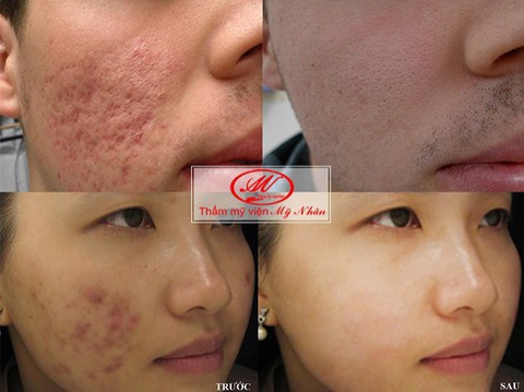 Phương pháp mới trị sẹo rỗ hiệu quả - Micro Needle Therapy (Đức) - Ảnh 2. Phương pháp mới trị sẹo rỗ hiệu quả - Micro Needle Therapy (Đức) - Ảnh 2.