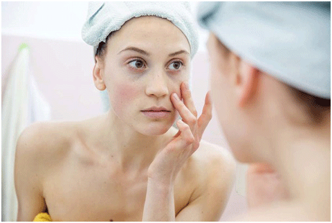 Chăm sóc da mụn - Ảnh 1. Chăm sóc da mụn - Ảnh 1.