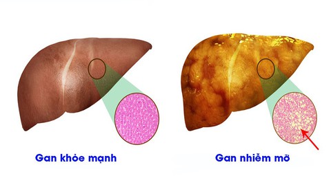 Hiểu đúng về bệnh gan nhiễm mỡ - Ảnh 1. Hiểu đúng về bệnh gan nhiễm mỡ - Ảnh 1.