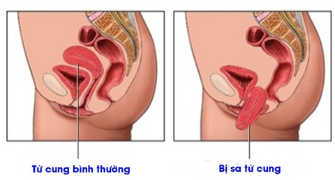 Vài điều cần biết về sa sinh dục - Ảnh 1. Vài điều cần biết về sa sinh dục - Ảnh 1.