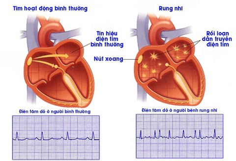Rung nhĩ: Những điều người bệnh tim cần biết - Ảnh 1. Rung nhĩ: Những điều người bệnh tim cần biết - Ảnh 1.