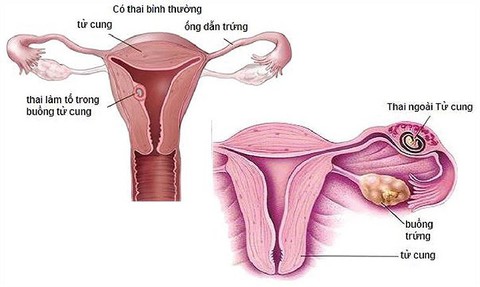 Thai ngoài tử cung - Ảnh 1. Thai ngoài tử cung - Ảnh 1.