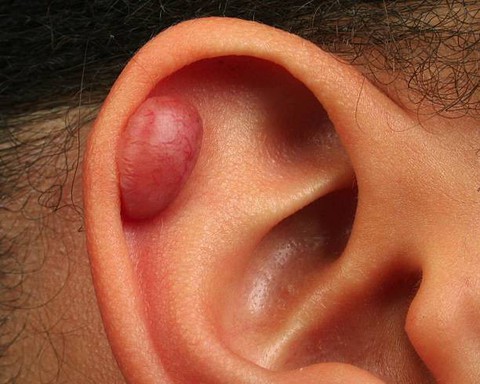 Các loại sẹo thường gặp - Ảnh 1. Các loại sẹo thường gặp - Ảnh 1.