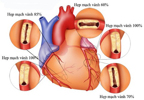 Hiểu biết về bệnh động mạch vành - Ảnh 1. Hiểu biết về bệnh động mạch vành - Ảnh 1.